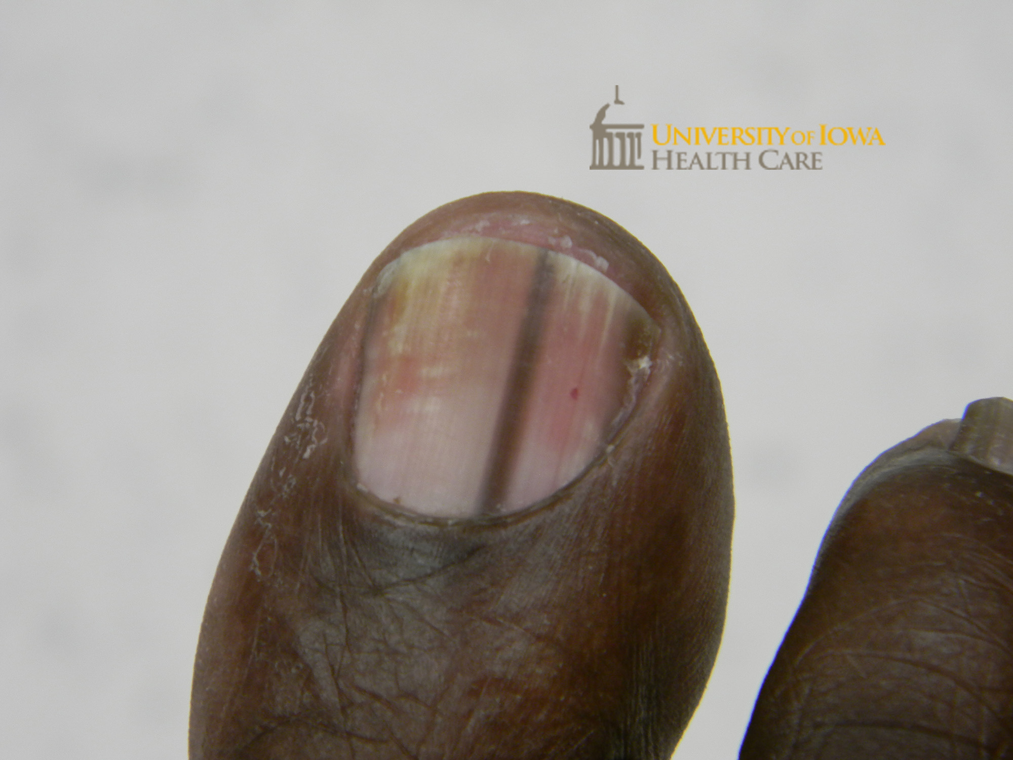 Longitudinal brown band on the toenail. (click images for higher resolution).